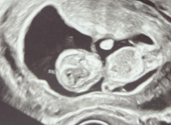 Bild zu Geschlecht durch Nub oder Ramzi? :) - Schwanger - wer noch? Rund um die Schwangerschaft