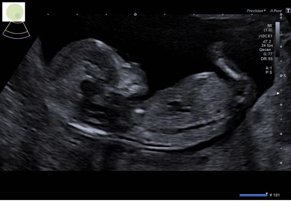 Bild zu Junge oder Mädchen? - Schwanger - wer noch? Rund um die Schwangerschaft