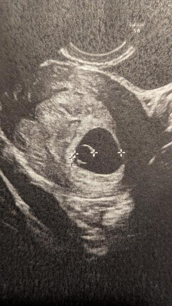Bild zu Woche 6+4 kein Embryo auf Ultraschall zu sehen - Schwanger - wer noch? Rund um die Schwangerschaft