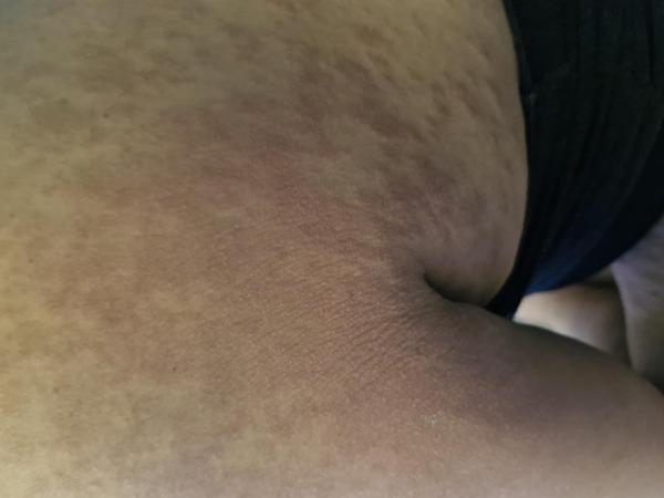 Bild zu PUPPP - Schwanger - wer noch? Rund um die Schwangerschaft