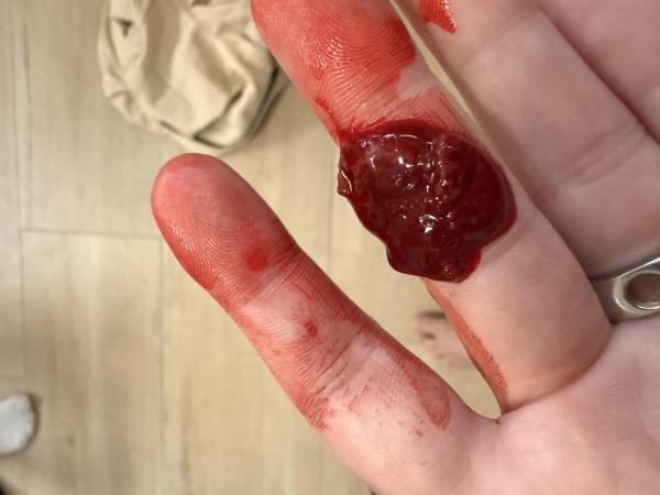 Bild zu Hämatom oder Fehlgeburt 10 ssw !Achtung Bilder! - Schwanger - wer noch? Rund um die Schwangerschaft