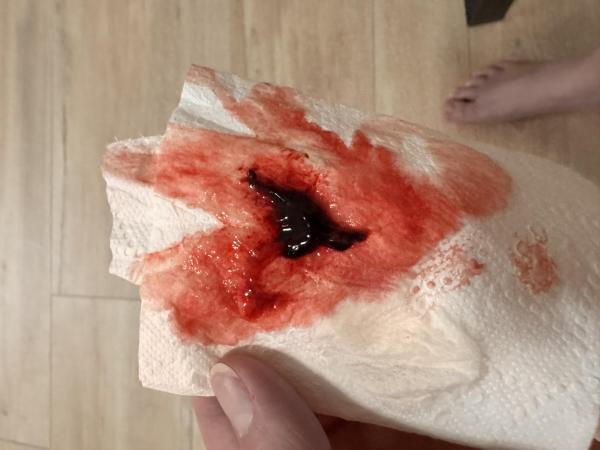 Bild zu Hämatom oder Fehlgeburt 10 ssw !Achtung Bilder! - Schwanger - wer noch? Rund um die Schwangerschaft