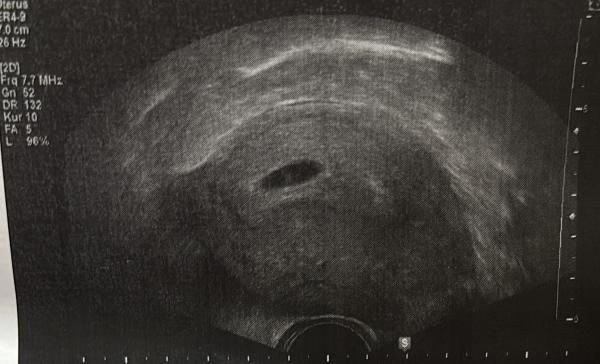 Bild zu 6+4 Ssw, kein Herzschlag - Schwanger - wer noch? Rund um die Schwangerschaft