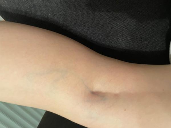 Bild zu Blaue Ader/Vene nach Abgang - Kinderwunsch nach Fehlgeburt