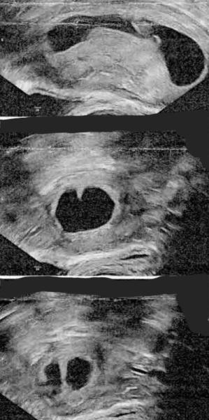 Bild zu 3 Fehlgeburten und eventuell Septum - Kinderwunsch nach Fehlgeburt