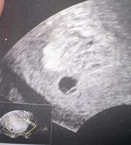 Bild zu Verdacht auf Blasenmole Erfahrungen - Kinderwunsch nach Fehlgeburt