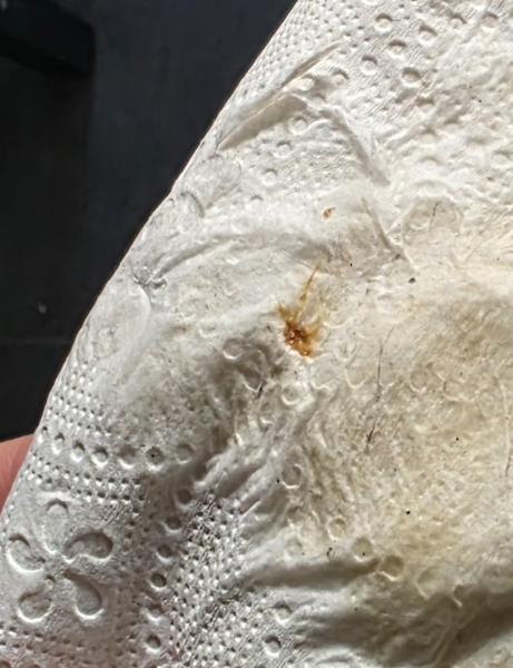 Bild zu Einistungsblutung? ACHTUNG BILD - Kinderwunsch nach Fehlgeburt