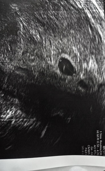 Bild zu 5+4 SSW Ultraschallbild? - Kinderwunsch nach Fehlgeburt
