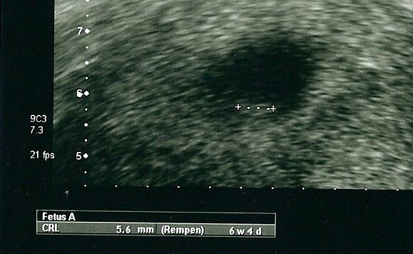 Bild zu Jetzt gibts auch von mir Viren ... - Kinderwunsch - bitte noch ein Baby
