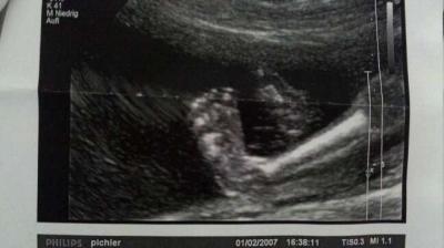 Bild zu @ frau von wunderfitz klumpfüsse auf ulltraschallbild - Kinderwunsch - bitte noch ein Baby