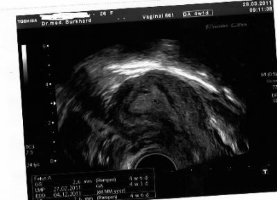 Bild zu Brauche euren Rat & eure Erfahrungen in der Frühschwangerschaft !!!! - Kinderwunsch - bitte noch ein Baby