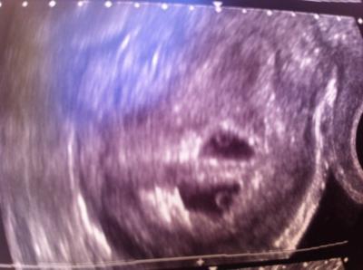 Bild zu Wollt mal berichten - Kinderwunsch - bitte noch ein Baby
