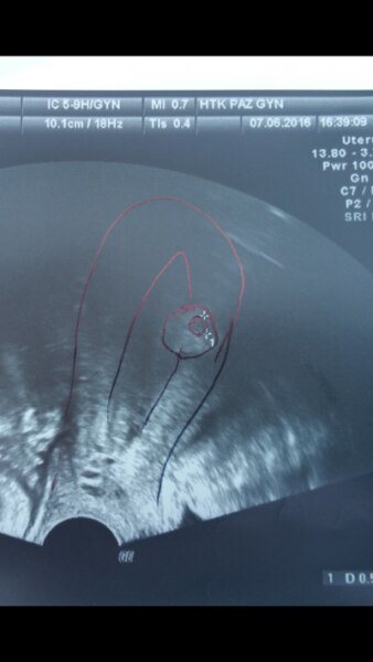 Bild zu Morgen Ultraschallkontrolle ....... - Kinderwunsch - bitte noch ein Baby