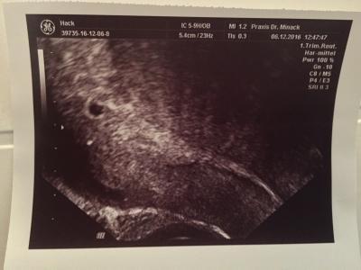 Bild zu 7. SSW Fruchthöhle kaum gewachsen - Kinderwunsch - bitte noch ein Baby