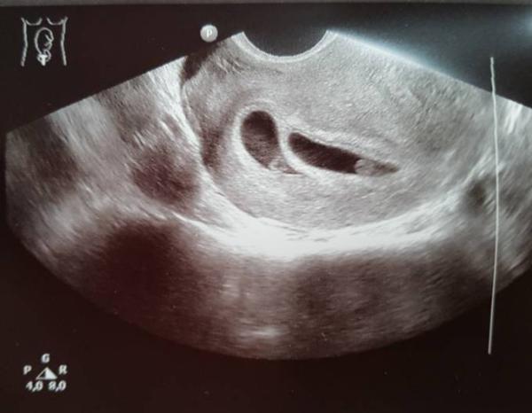 Bild zu Kontrolle - Alles gut :) - Kinderwunsch - bitte noch ein Baby