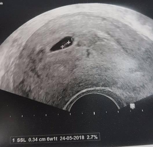 Bild zu Heute FA Termin gehabt... - Kinderwunsch - bitte noch ein Baby