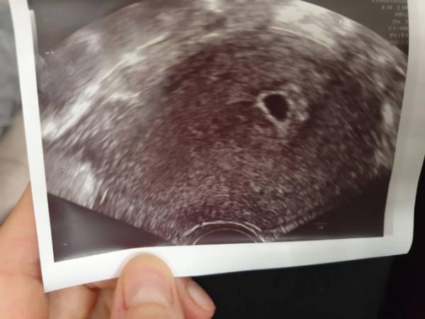 Bild zu Ssw8 leere fruchthöhle :,( - Kinderwunsch - bitte noch ein Baby