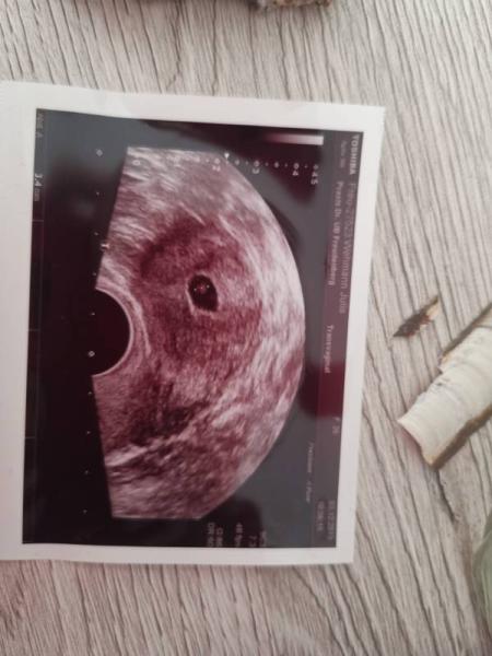 Bild zu Ultraschall positiv, bluttest negativ - Kinderwunsch - bitte noch ein Baby