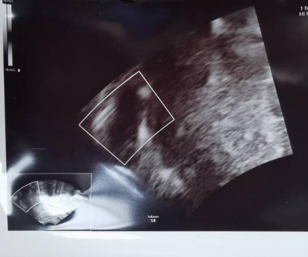 Bild zu Leere Fruchthöhle in der 7ssw - Kinderwunsch - bitte noch ein Baby