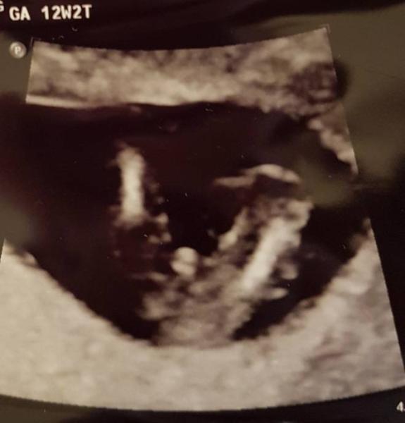 Bild zu Könnt ihr das Geschlecht erkennen? 13 ssw siehe Bild - Kinderwunsch - bitte noch ein Baby