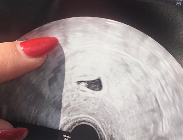 Bild zu 7 ssw - Kinderwunsch - bitte noch ein Baby