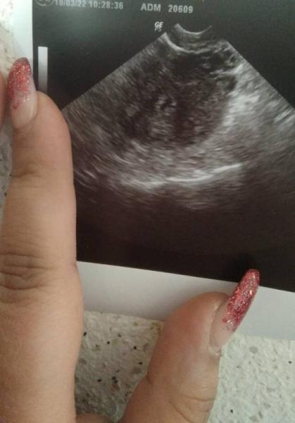 Bild zu 6ssw verunsichert - Kinderwunsch - bitte noch ein Baby