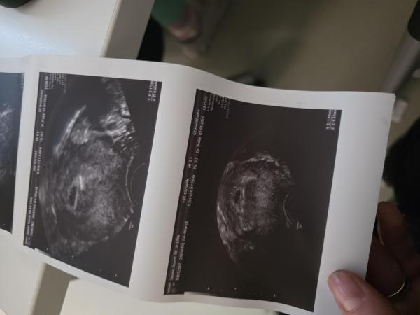 Bild zu Ultraschall 5+4 zeitgemäß? - Kinderwunsch - bitte noch ein Baby