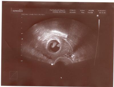 Bild zu US-Bildchen - Kinderwunschbehandlung