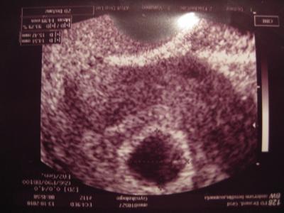 Bild zu Bericht vom heutigen US mit ersten Bildchen - Kinderwunschbehandlung