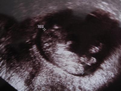 Bild zu Hallo ihr Lieben - US-Bild vom Zwergi - Kinderwunschbehandlung