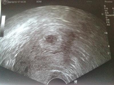 Bild zu Es war/ist ein Hämatom, das Baby ist noch da !!!!! - Kinderwunschbehandlung