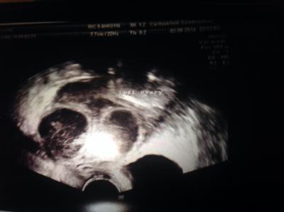 Bild zu Leute Hilfe!!!!!! Bitte!!!! - Kinderwunschbehandlung