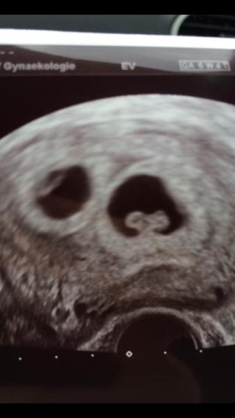 Bild zu 1. Icsi und Zwillinge - Kinderwunschbehandlung