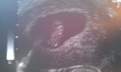 Bild zu Wollte euch mal mitteilen, wie der Stand bei mir ist ;) - Kinderwunschbehandlung