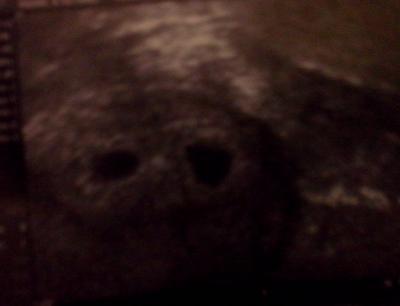 Bild zu 2 Weihnachtswunder - Kinderwunschbehandlung