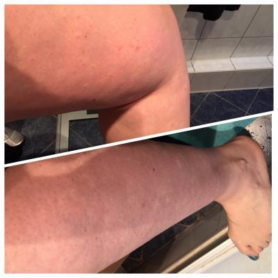 Bild zu Allergische Reaktion auf decapepthyl? - Kinderwunschbehandlung