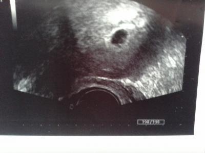 Bild zu dottersack nicht mehr sichtbar - Kinderwunschbehandlung