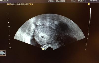 Bild zu Das ein US erleichtern kann. - Kinderwunschbehandlung