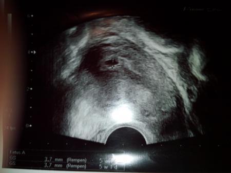 Bild zu wie war es bei euch??? - Kinderwunschbehandlung