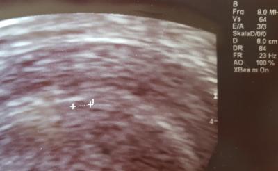 Bild zu Nach positiven BT immernoch nervös und ägstlich! - Kinderwunschbehandlung