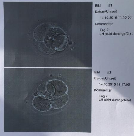 Bild zu Erste icsi - Kinderwunschbehandlung