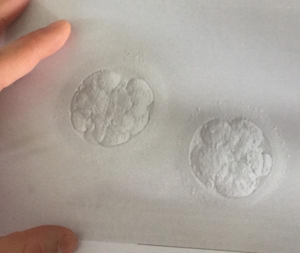 Bild zu 3. icsi - Kinderwunschbehandlung