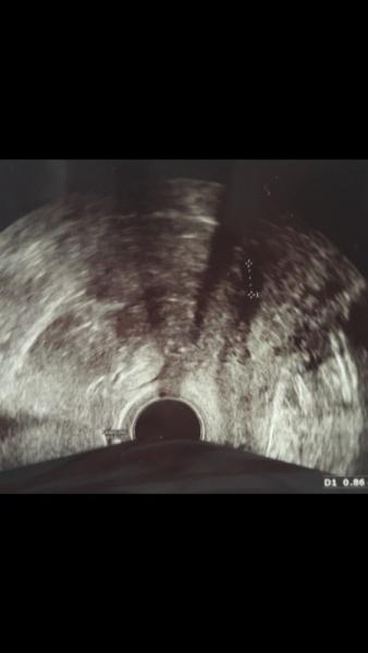 Bild zu War heute beim ersten Baby TV - Kinderwunschbehandlung