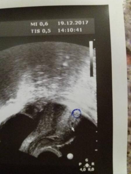 Bild zu Ultraschall nach Icsi - Kinderwunschbehandlung