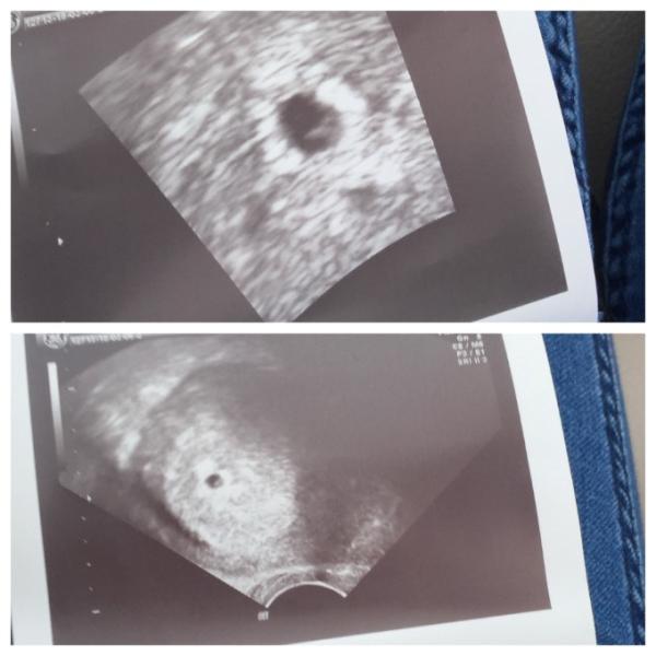 Bild zu Unglaublich < 3 Ultraschal - Kinderwunschbehandlung