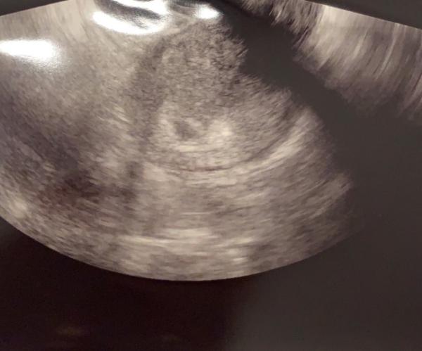 Bild zu Erster Ultraschall nach ICSI , Fruchthöhle schwammig ? - Kinderwunschbehandlung