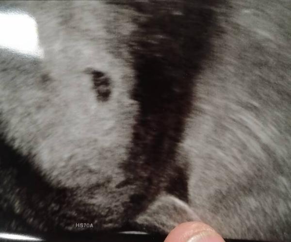 Bild zu Gute Nachricht und traurige 😢 - Kinderwunschbehandlung