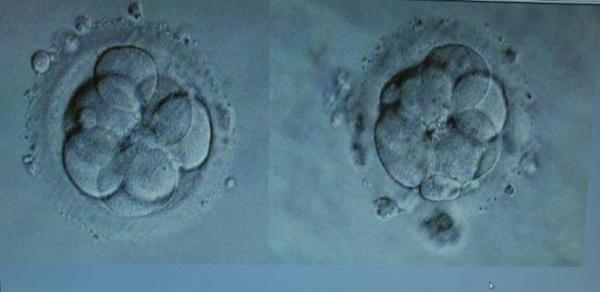 Bild zu Icsi Geschwisterkind - Kinderwunschbehandlung