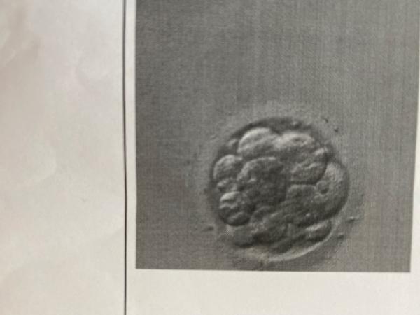 Bild zu Ivf Embyrotransfer 10 Zeller an Pu+4 wie sehen die Chancen aus?? - Kinderwunschbehandlung