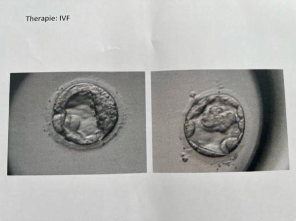 Bild zu Gestern Transfer - 2 Blastos (siehe Bild) - Kinderwunschbehandlung
